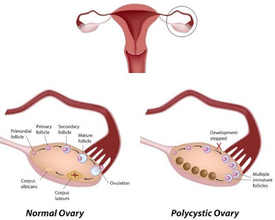 Acne During Ovulation