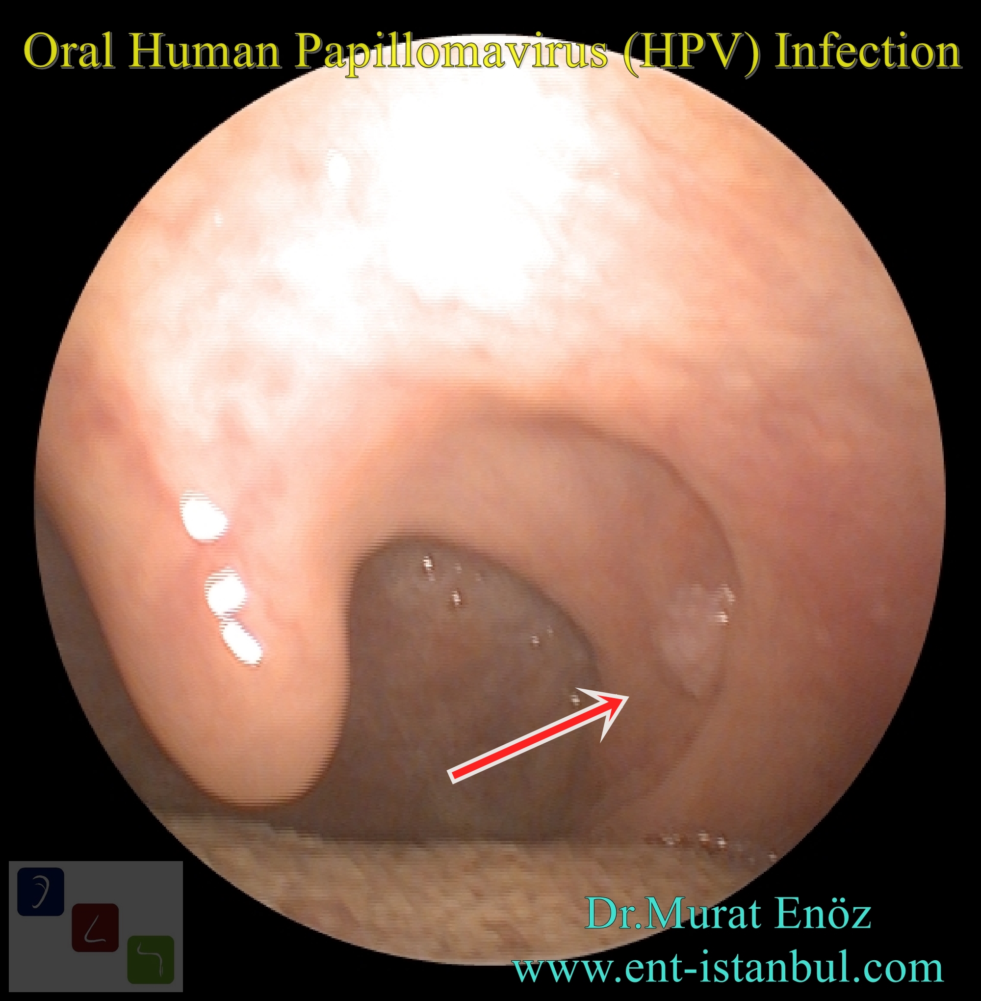 Operation lesion papillomavirus