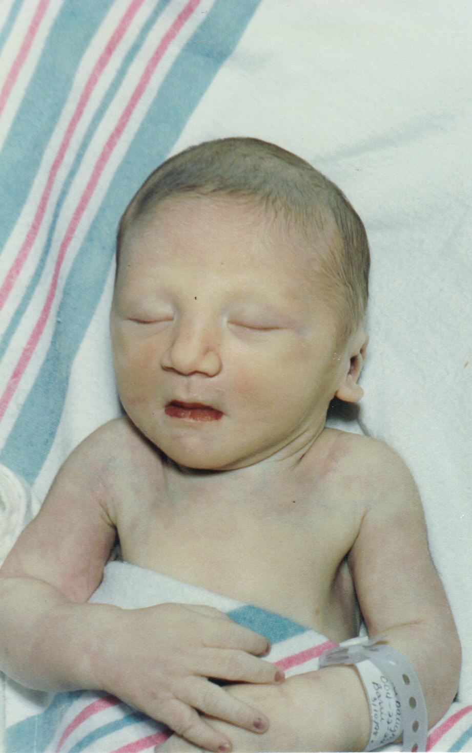 Potter's Syndrome September 2011