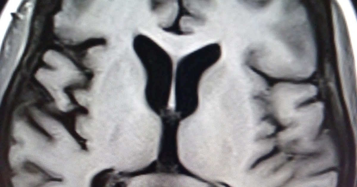 Neurodegeneration with Brain Iron Accumulation (NBIA) MRI Sumer's
