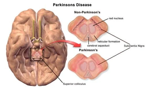 Askep Penyakit Parkinson, Teori dan Konsep