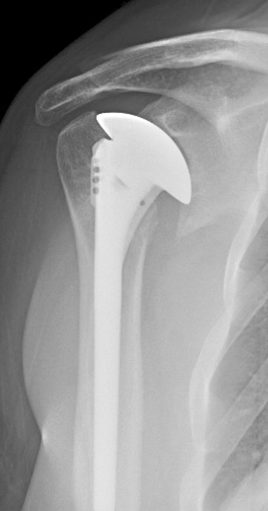 Shoulder Arthritis / Rotator Cuff Tears / Shoulder Pain