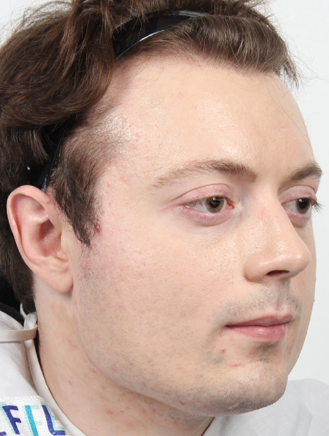 EFIL Bulging Eyes Plastic Surgery JCI What is exophthalmos?