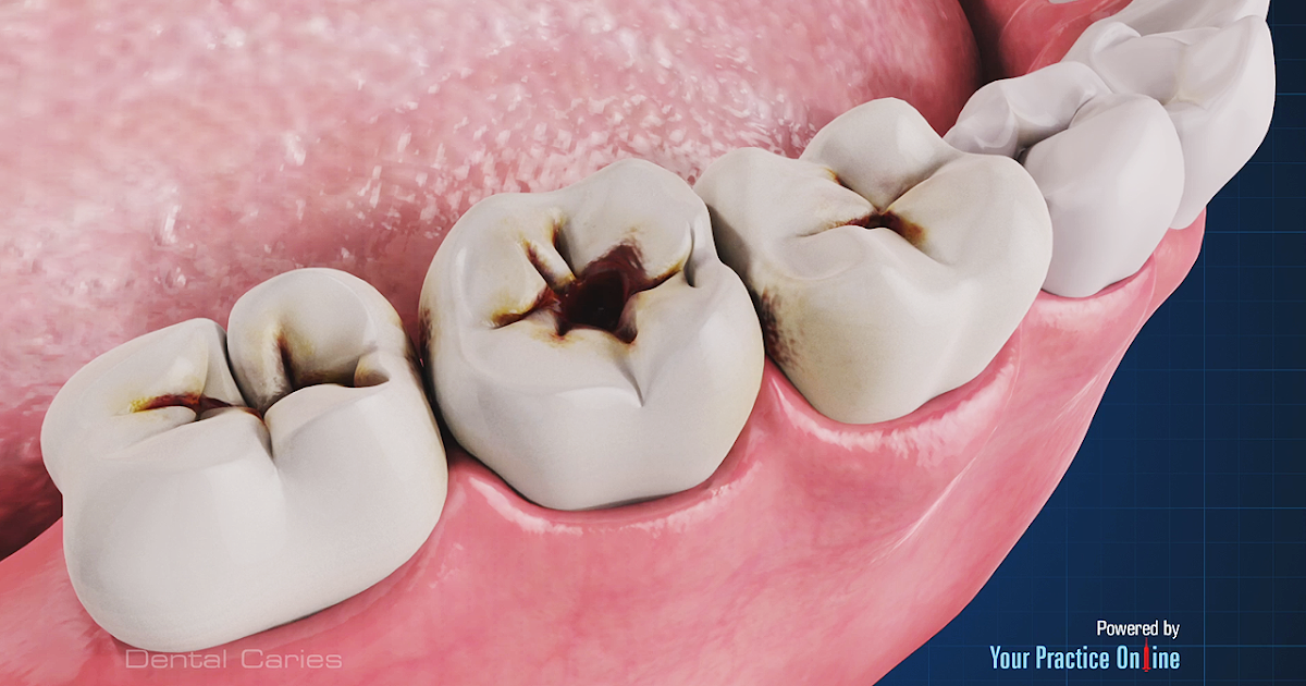 Dental Cariology (7)