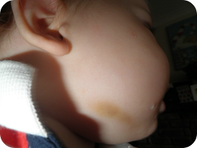 bruised baby, toddler learning to walk and bruised