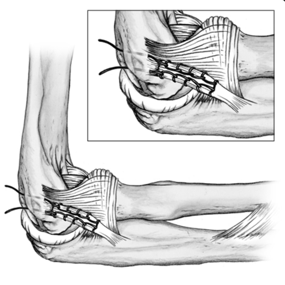 Shoulder and Elbow Surgery Terrible triad injury. The importance of