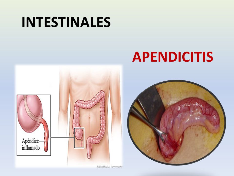 CUIDADO CON EL APENDICITIS DXN SALUD Y BELLEZA DXN SALUD Y BELLEZA