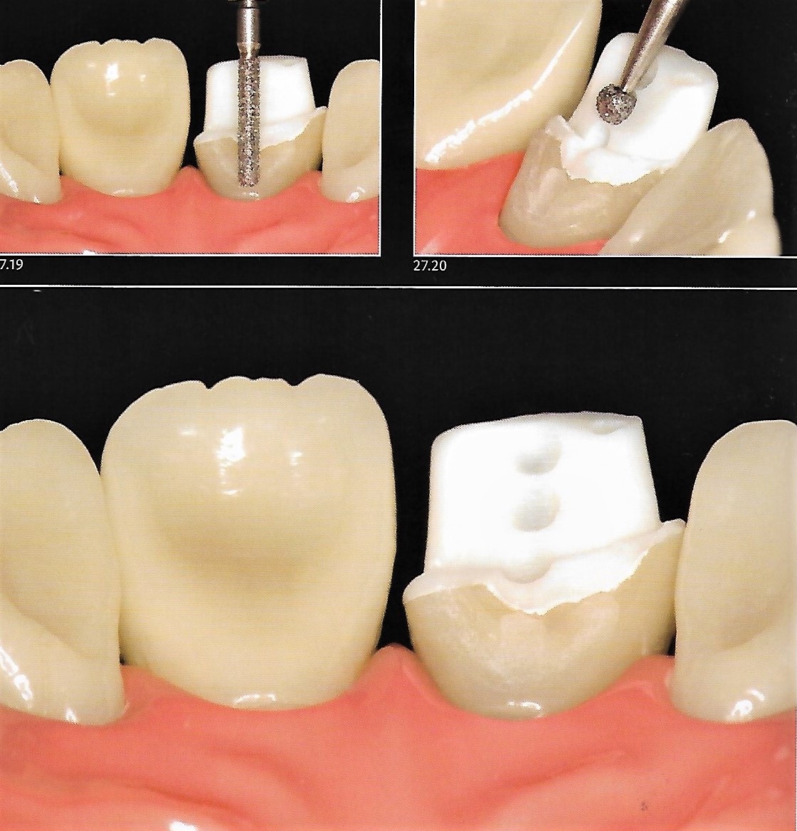 Anterior Crown Preparation Dental Esthetics