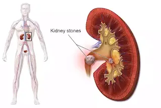 10 Useful Home remedies for kidney stones