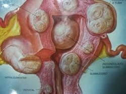 Pengobatan Alami Miom Secara Tradisional Pengobatan Alami Miom Secara Tradisional