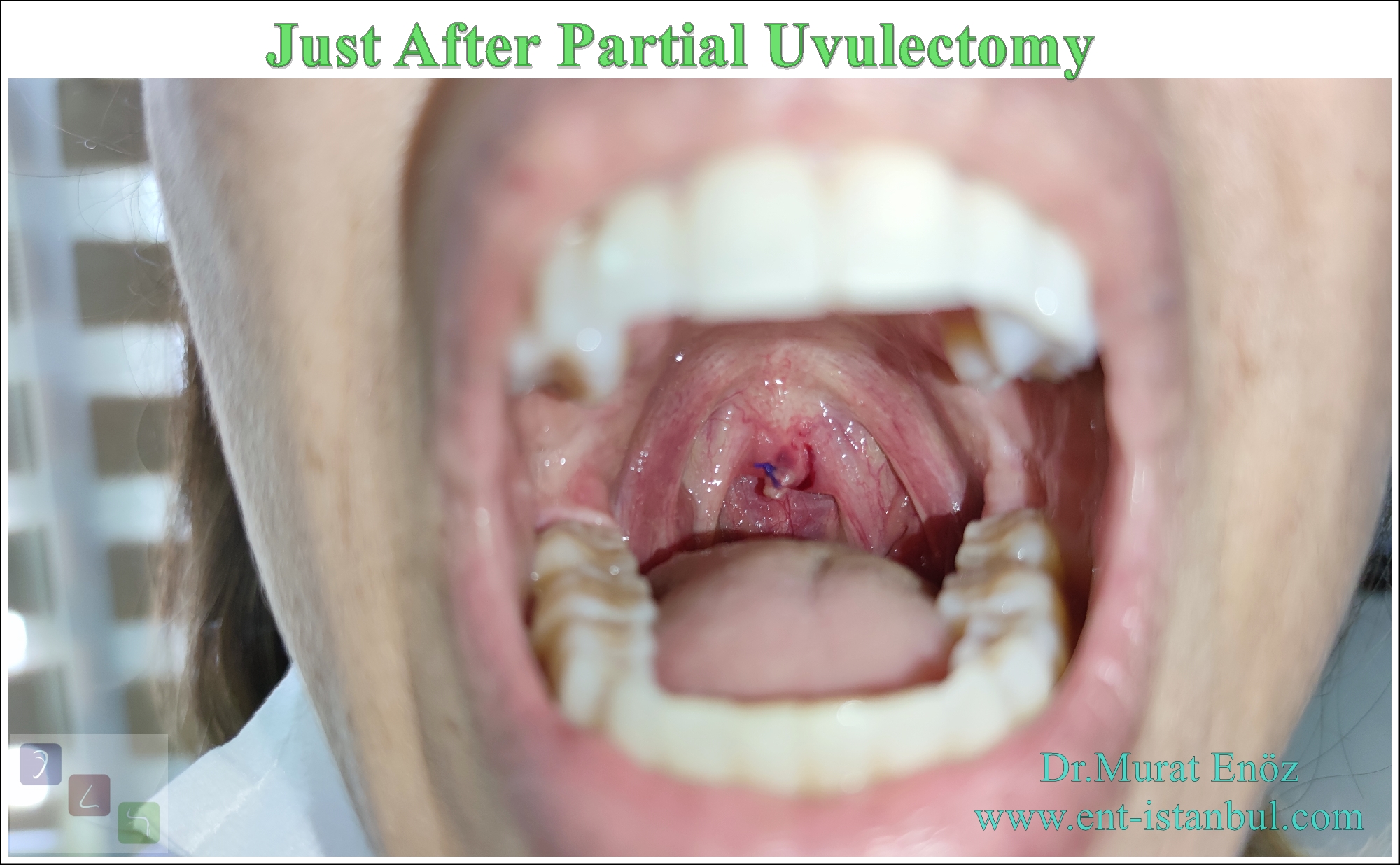 A Simple Partial Uvulectomy Technique Under Local Anesthesia For The