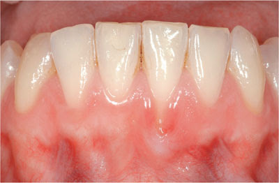 Tác hại của chân răng bị hở là gì?