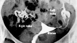 Obat Herbal Tuba Falopi Non Paten