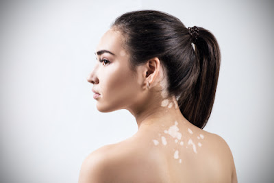 http://dermatologist-skin-clinic.com/skin/vitiligo/
