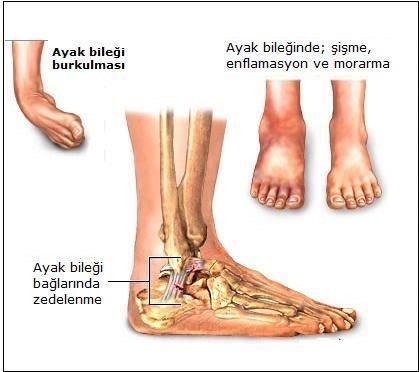 Burkulma Ve Incinmelerde Rehabilitasyon Burkulma Ve Incinmelerde Rehabilitasyon