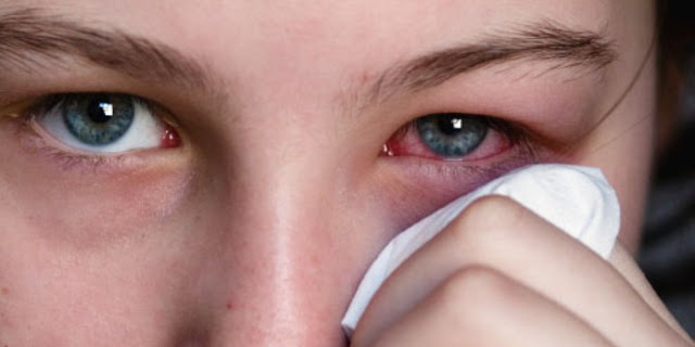 مرض الرمد الربيعي مرض الرمد الربيعي