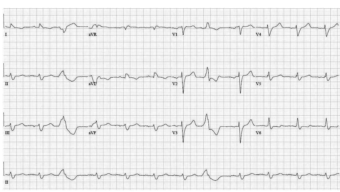 ECG Rhythms: Hyperkalemia in a patient with pacemaker