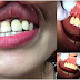 3 giai đoạn thực hiện bọc răng sứ bị vỡ tại nha khoa