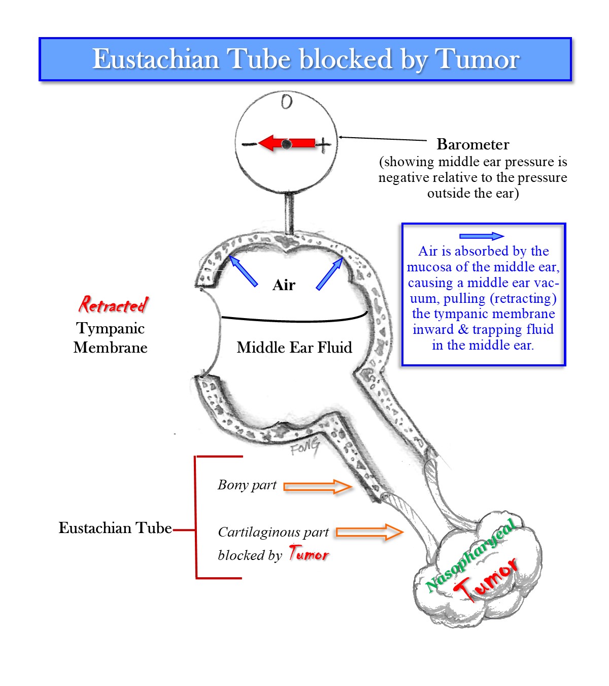 Eustachian Tube Blockage, Otitis Media and Nasopharynx Tumors