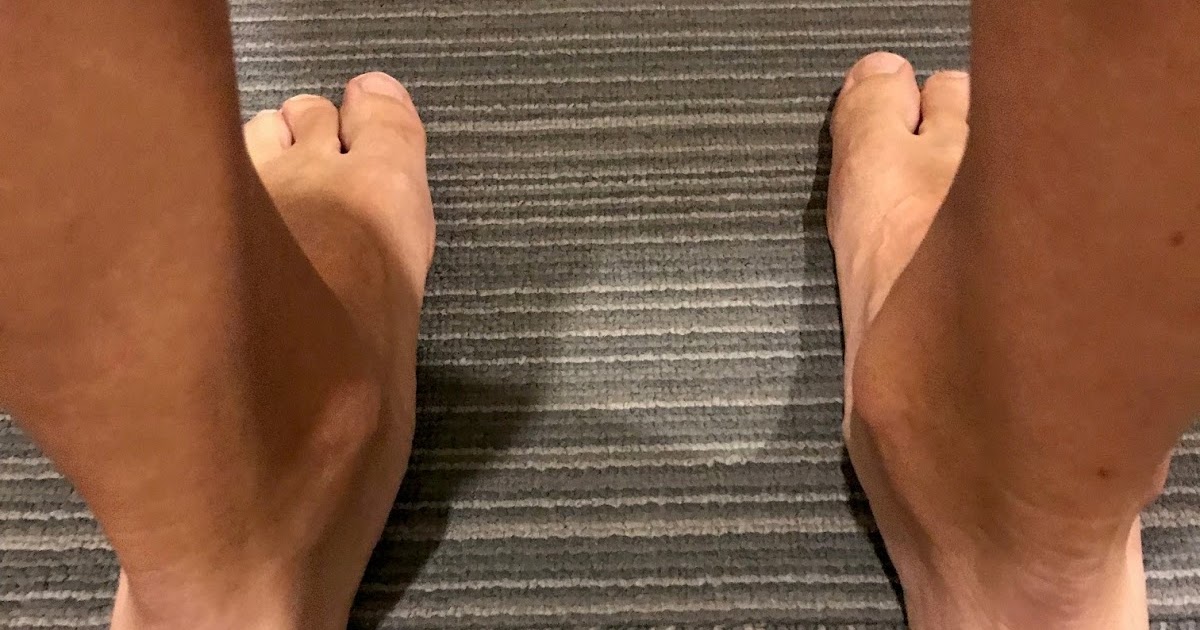 Running Solutions "Collapsed" Arches And Tibialis Posterior Muscle Pain