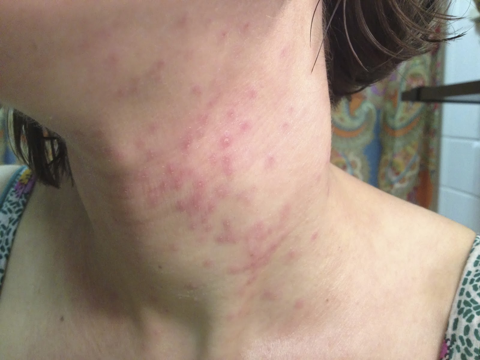 My Journey With Itchy Skin January 2014