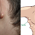 Cyst and Lipomas: Causes, Symptoms, And Natural Remedy To Remove 100% Using Natural Ingredients