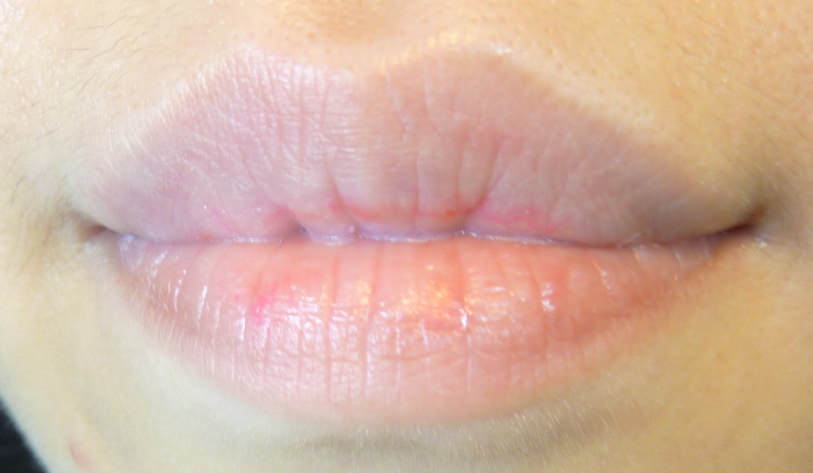 milia on lip #10