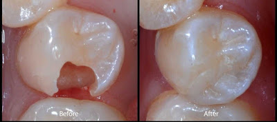 Bọc răng sứ một giải pháp mới cho răng sâu nên biết
