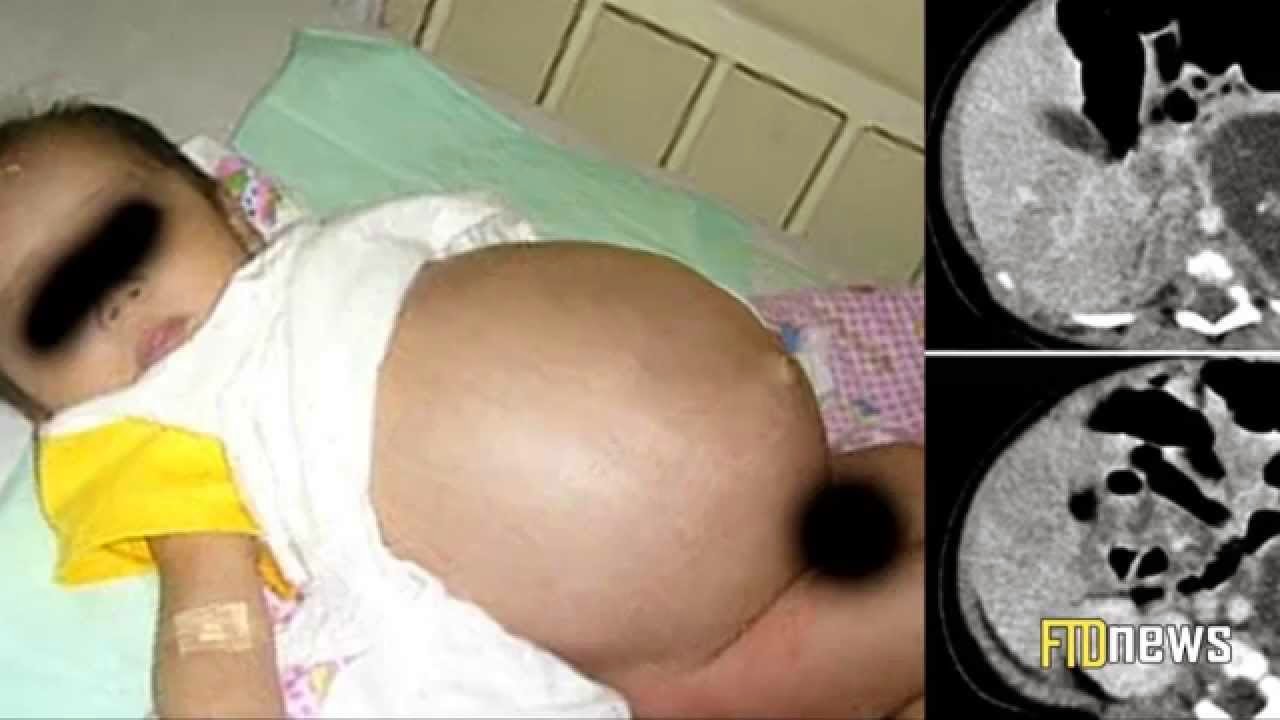 Baby girl in China born pregnant with twins.