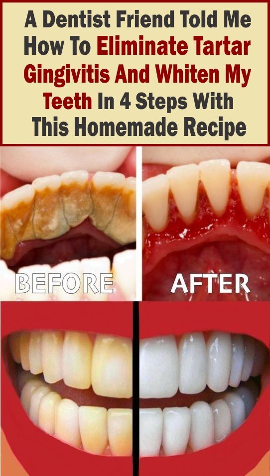 A Dentist Friend Told Me How To Eliminate Tartar, Gingivitis And Whiten