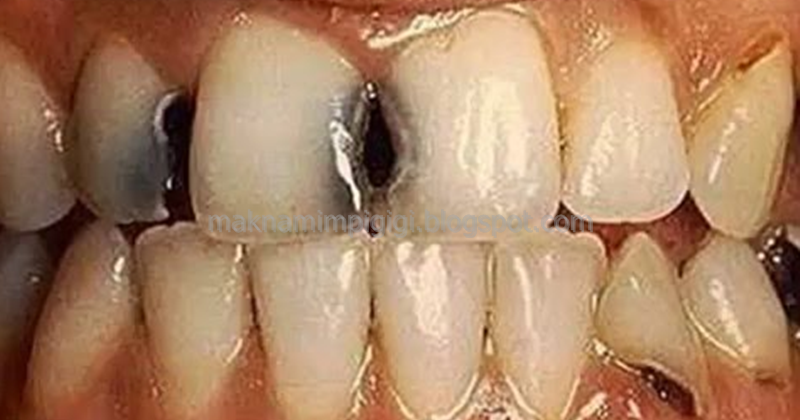 99 Arti Mimpi Melihat Gigi Hitam Menurut Primbon Jawa Dan Tafsir Islam Lengkap Mimpi Gigi