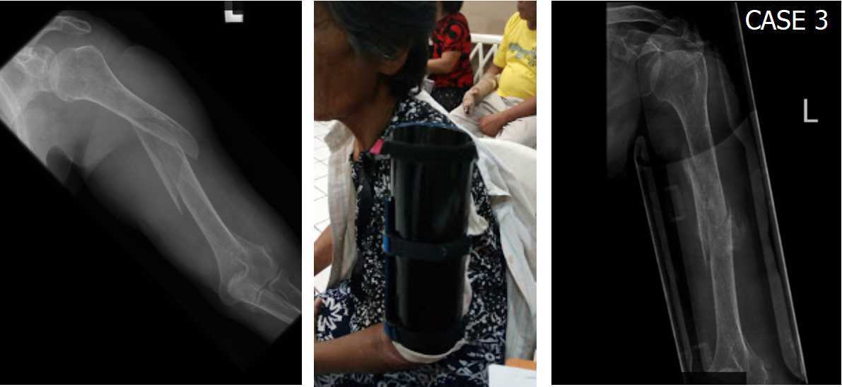 . MAKING HUMERAL FRACTURE BRACES USING PVC PIPES