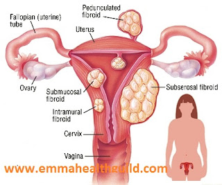 fibroid