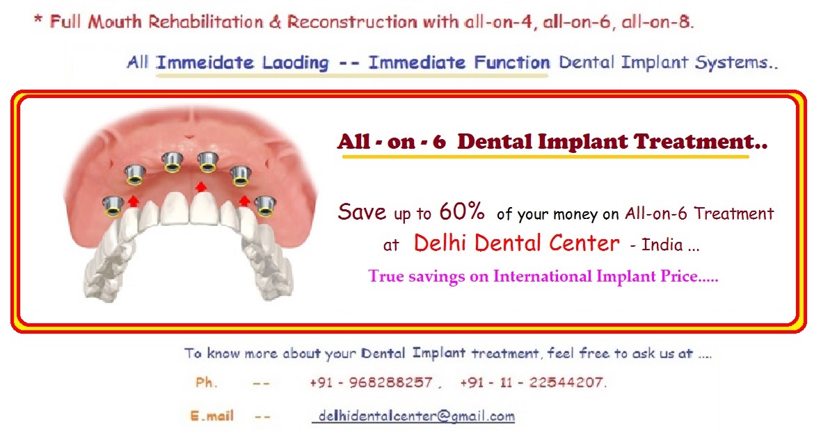 allon6 cost, allon6 implants cost in India, cost of allon6 in India, allon6 price in