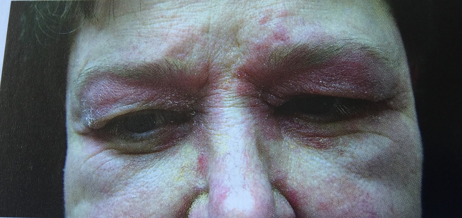 Las vitaminas la omega-3 a la psoriasis
