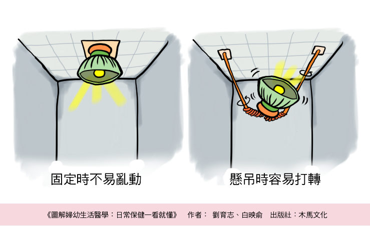 卵巢扭轉-照護線上 什麼是卵巢扭轉?