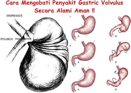 Obat Tradisional Gastric Volvulus