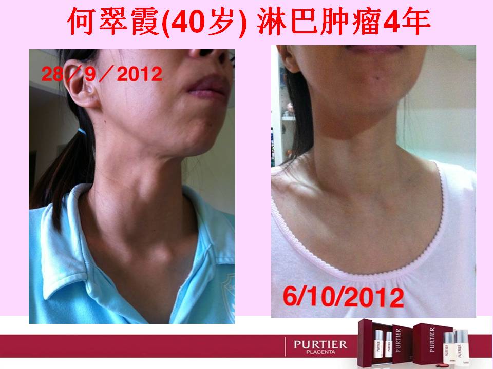 MS HO (40) - SWOLLEN LYMPH NODES FOR 4 YEARS