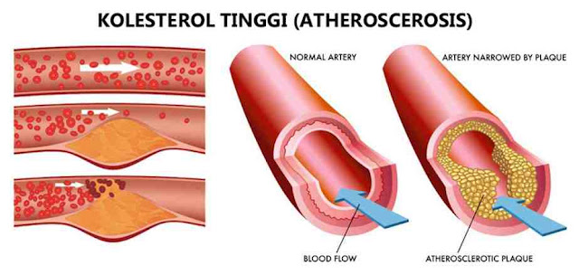  Cara alami di sini maksudnya dengan mengonsumsi bahan-bahan alami yang ada disekitar serta menjalani gaya hidup yang sehat.