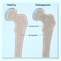 osteoporose e implante dentário
