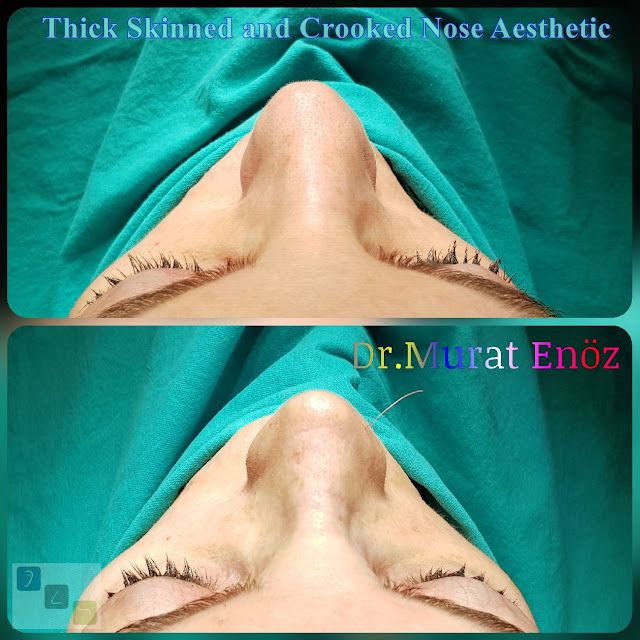 Crooked Nose Aesthetic,Female Nose Job, Rhinoplasty in Istanbul