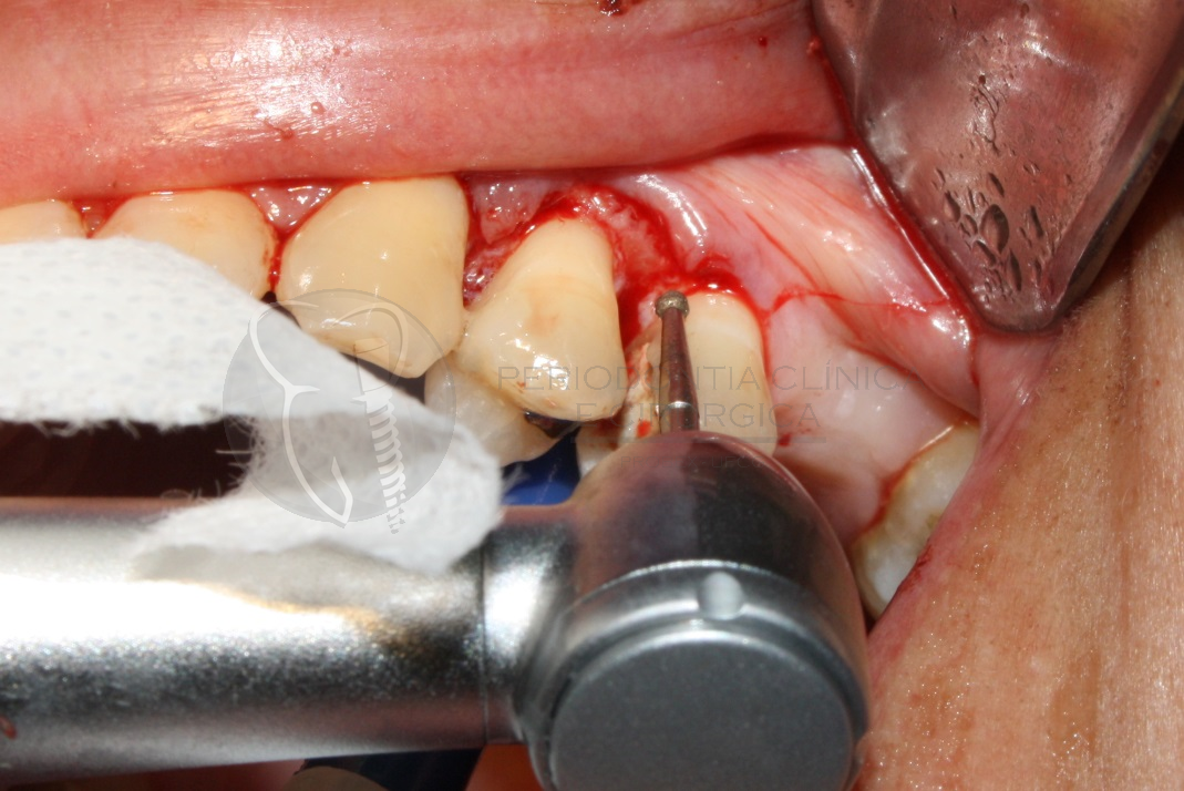 Recuperação das distâncias biológicas periodontais: Relato de caso