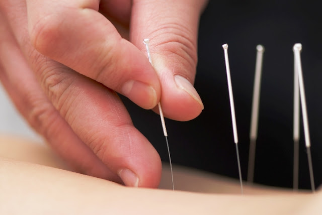 Acupuncture and Natural Therapies for Diabetes