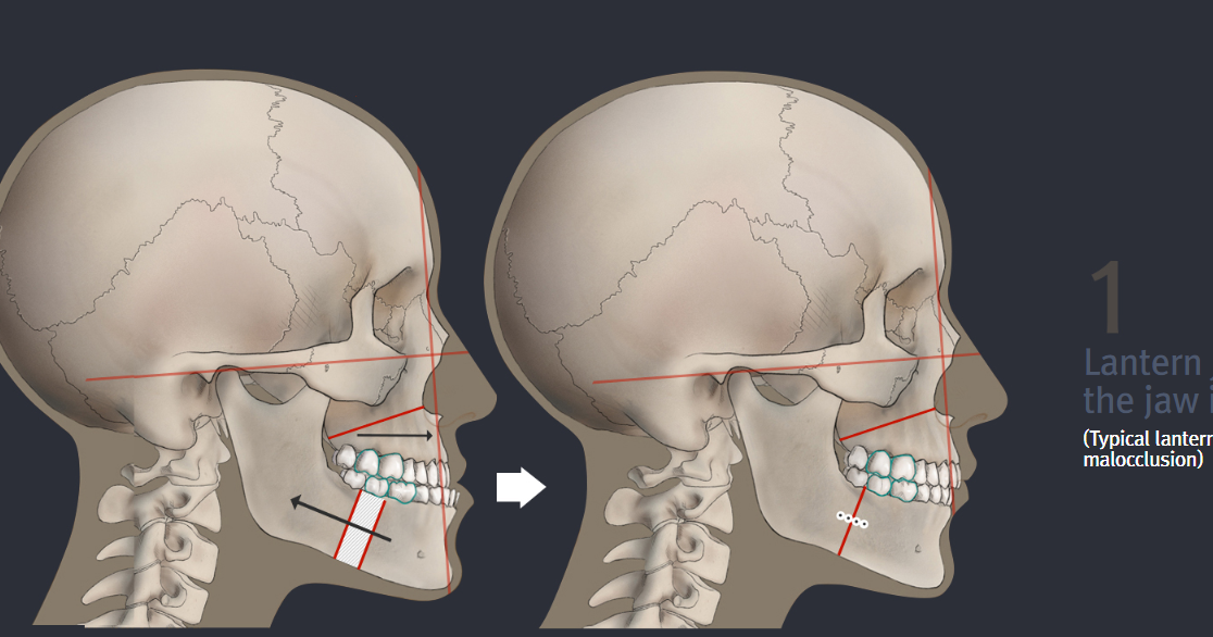 Lantern Jaw & Protruded Mouth Surgery? EUSURGERY