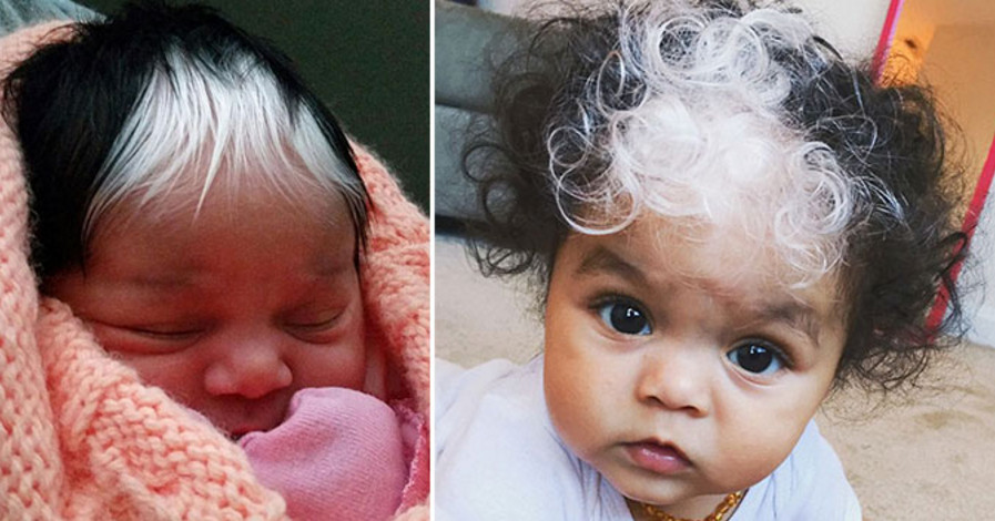 Baby Born With A White Patch Of Hair Look At Her Mum So Special
