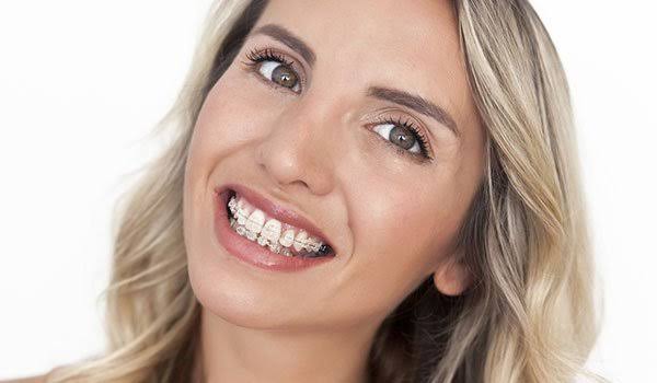 Orthodontic Treatment For Adult Braces