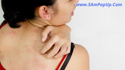 Indian Home Remedy For Skin Allergy | स्किन एलर्जी के घरेलू उपचार