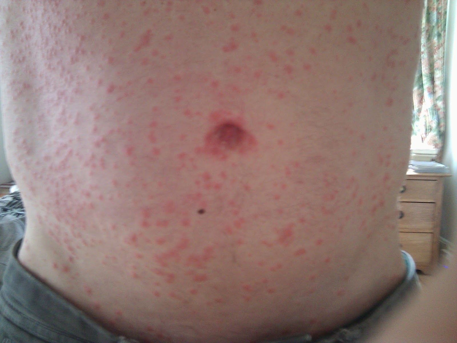 Lobulo Infectado MEDICINA