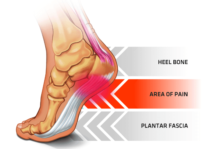Plantar-Fasciitis-Foot-Anatomy.png