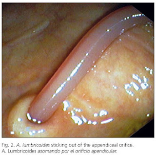 Ascaris peték az emberi ürülékben férgek által okozott fertőzés